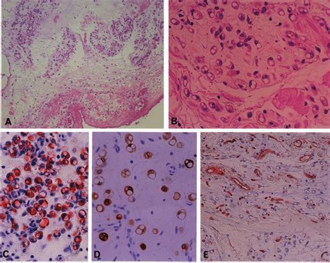 Histology and immunohistochemistry of the lesion. (a) The thickened ...