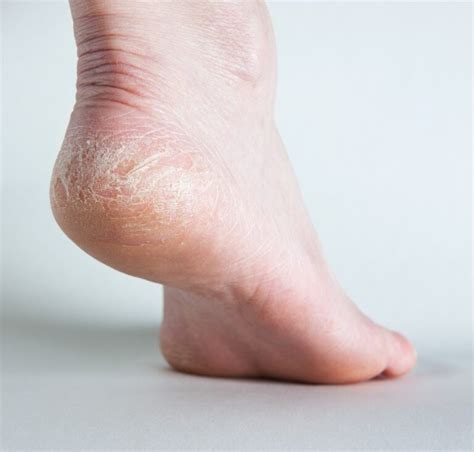 Sores on Bottom of Feet Causes, Symptoms and Treatments - American Celiac