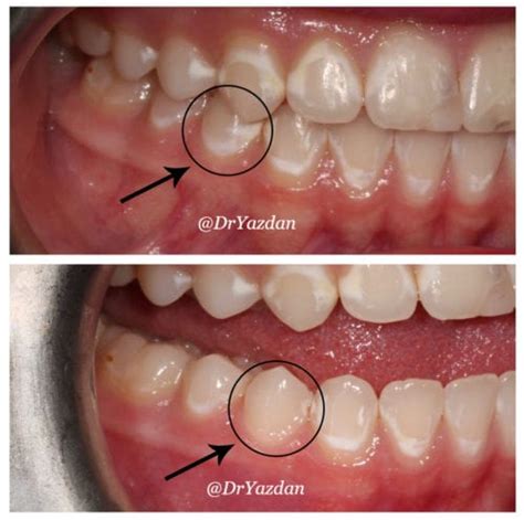 How To Get Rid Of White Bits On Teeth - TeethWalls