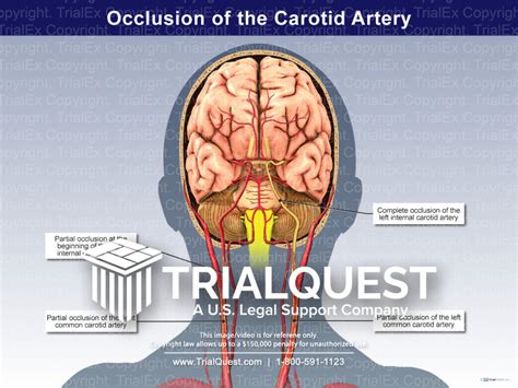 Occlusion of the Carotid Artery - TrialExhibits Inc.