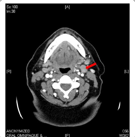 Ct Scan Lymph Nodes