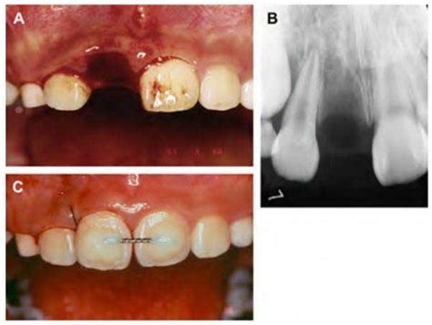 Avulsed tooth | Knocked tooth