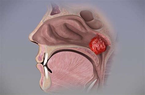 Tonsils: What Do Tonsils Do?