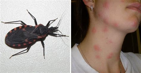 Beware of “Kissing Bugs” They May Sound Cute But They Are Actually Dangerous – Elite Readers