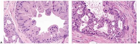 Apocrine Carcinoma | Basicmedical Key