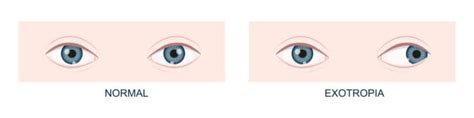 Exotropia (Eye Misalignment): Causes, Types and Treatment