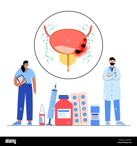 Bladder cancer stages, illustration Stock Photo - Alamy