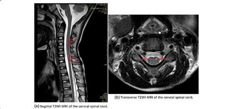 Sagittal and Transverse T2WI MRI of the cervical spinal cord. *Note ...