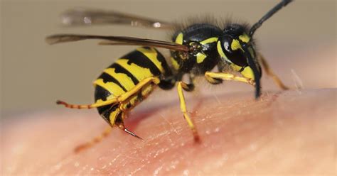 Wasp Stings: Symptoms, Anaphylaxis, Treatments & Complications