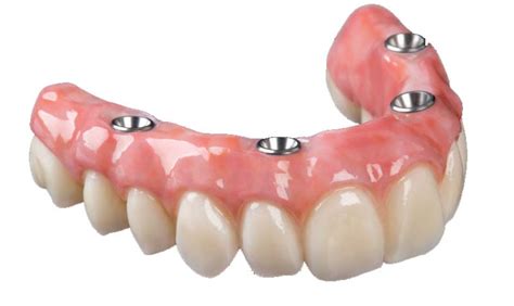 Implant Retained Dentures Give Greater Stability and Confidence