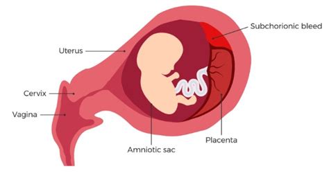 Subchorionic Bleeding (Hematoma) in Pregnancy: Detection and Causes