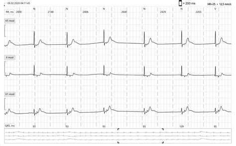 Junctional Escape Rhythm, Very Slow | ECG Guru - Instructor Resources