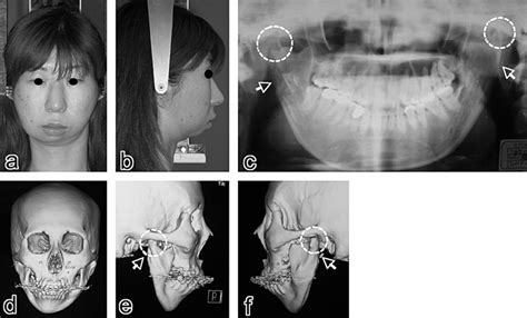 24-year-old patient with bilateral hypoplasia of the mandibular ...