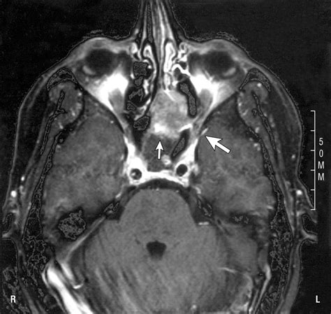 Fibrous Dysplasia Involving the Skull Base and Temporal Bone | Headache ...