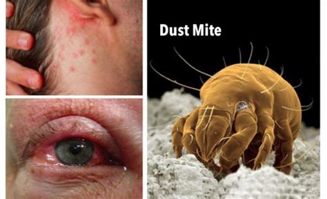 Skin Irritations and Watery Eyes? Dust Mites are Probably the Problem-Eliminate Them ASAP ...