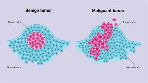 Benign vs Malignant Tumors | Technology Networks