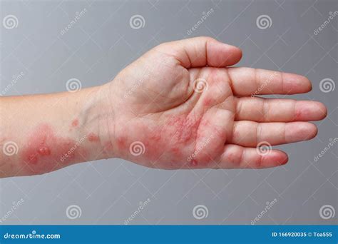 Shingles, Zoster or Herpes Zoster Symptoms on Arm Stock Image - Image of pimply, blistering ...