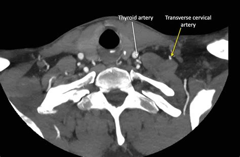 Cervical Lymph Node Stations Radiopaedia