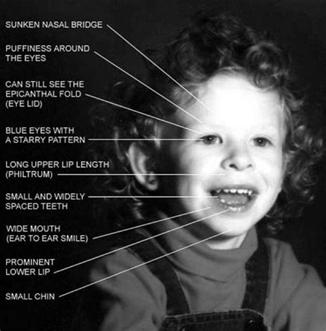 Williams Syndrome - Pictures, Causes, Symptoms, Treatment, Life ...