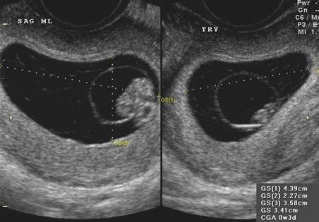 Amniotic Sac Ultrasound