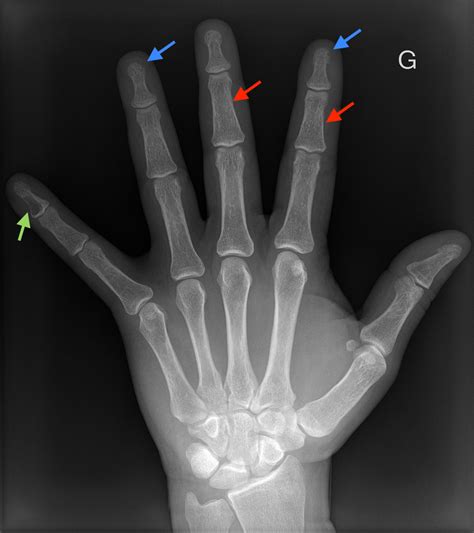 Osteitis Fibrosa Cystica Brown Tumor