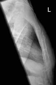 Delayed Complications of Sternal Fractures - SGEMHOP - SOCMOB Blog