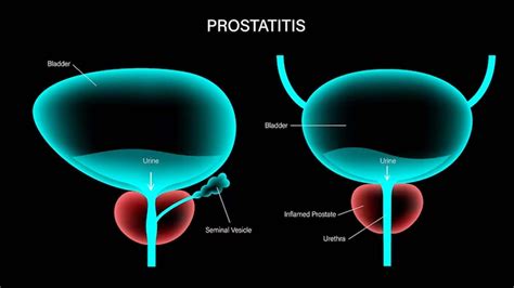 Can Prostatitis Cause Bowel Problems? – NutritionFact.in