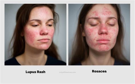 Lupus Rash vs Rosacea: What's the Difference? (2024)