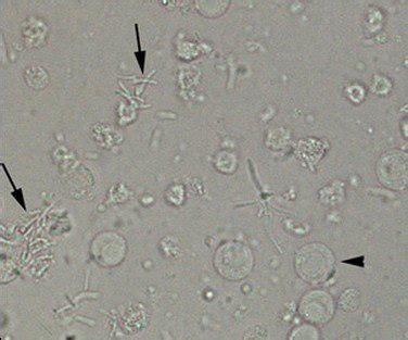 Bacteria in urine sediments | Medical Laboratories