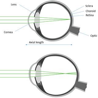 Schematic overview of (A) emmetropia and (B) myopia. In emmetropia, the ...