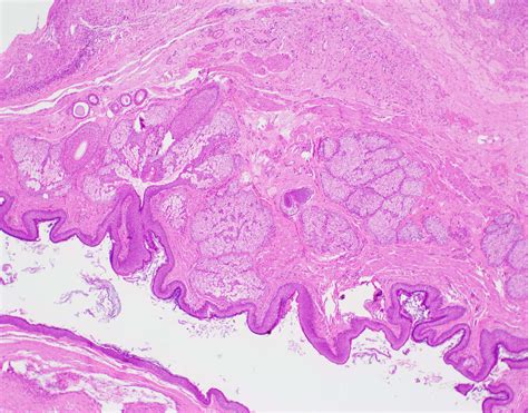 Dermoid cyst (mature cystic teratoma) (Ovary) – BosnianPathology