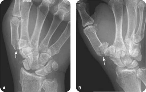 Types Of Thumb Fractures