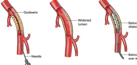 PERIPHERAL ANGIOGRAPHY AND ANGIOPLASTY | Dr. Tejas V. Patel | Cardiologist in Ahmedabad