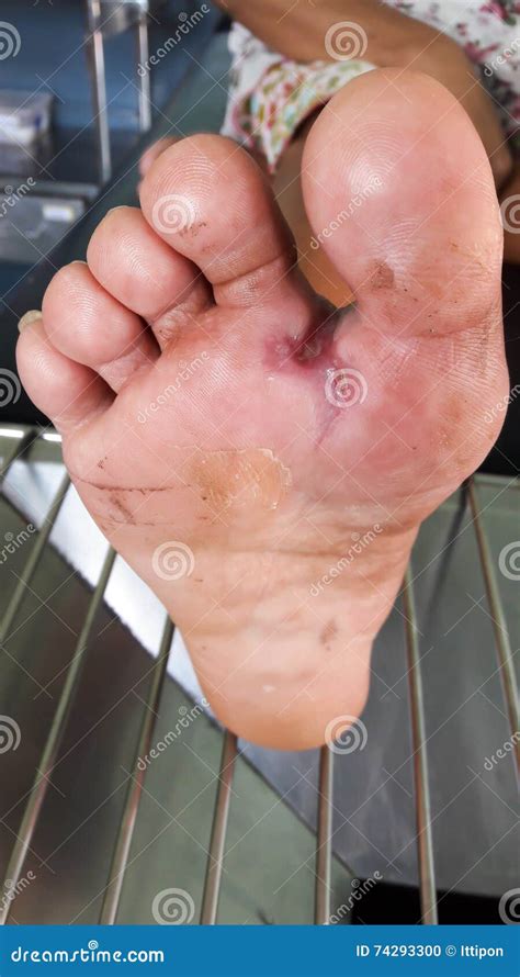 Wound of diabetic foot stock photo. Image of hurt, foot - 74293300