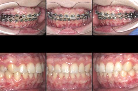 Class II Occlusion Anomaly Corrective Jaw Surgery - Corrective Jaw Surgery - Dr. Antipov