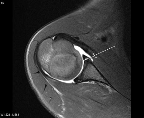 Mri Arthrogram, Glenoid Labral Tear | Mri, Medical imaging, Radiology