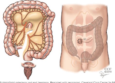 Figure 4 from Management of acute colitis and toxic megacolon ...