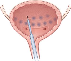 Q Does Botox relieve urinary urgency and urge incontinence? | MDedge ObGyn