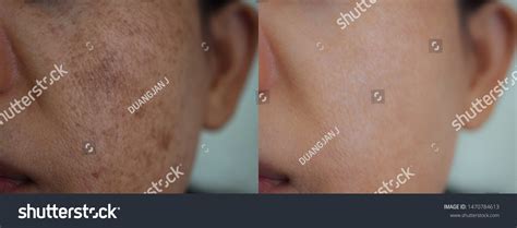 Before After Melasma Skin Images: Browse 247 Stock Photos & Vectors Free Download with Trial ...