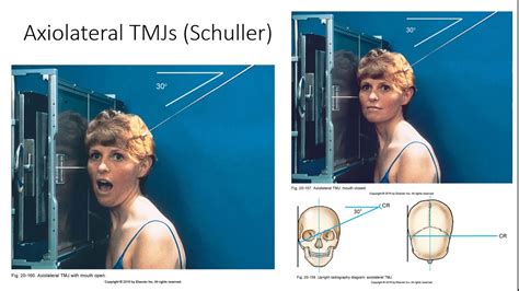 Radiographic Positioning of the TMJs - YouTube