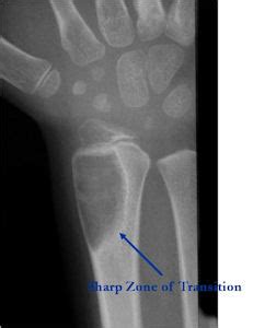 Osteoblastoma : Bone Tumor Cancer : Tumors of the bone