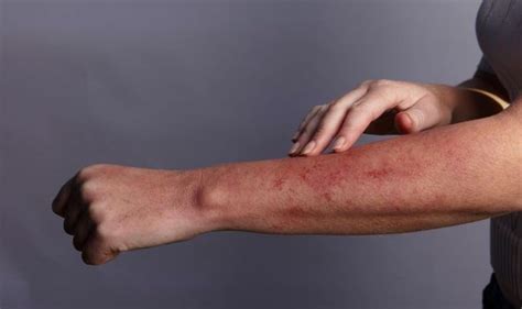 Heat rash: How long does prickly heat take to go away? | Express.co.uk