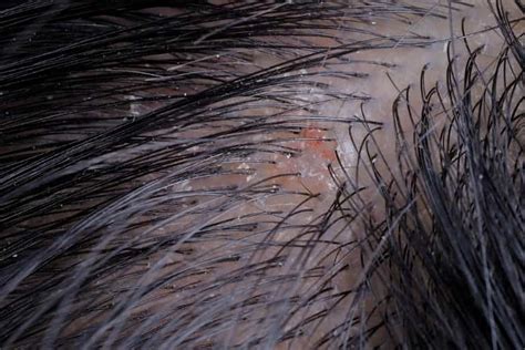 Scabs and Sores on Scalp: 17 Causes, Pictures and Treatment