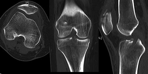 CT scan of the right knee 6 weeks postoperatively. | Download ...