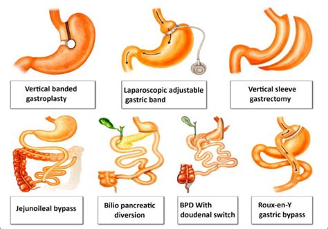 Vertical Banded Gastroplasty Complications