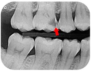 Why Do I Need X-Rays When I Visit the Dentist? - Twinkle