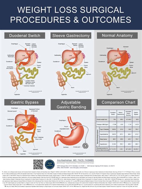 Outcomes Comparison Chart for Surgical Weight Loss Procedures - DSSurgery