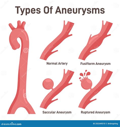 Thoracoabdominal Aortic Aneurysms Types. Healthy Aorta And Aorta Vector Illustration ...