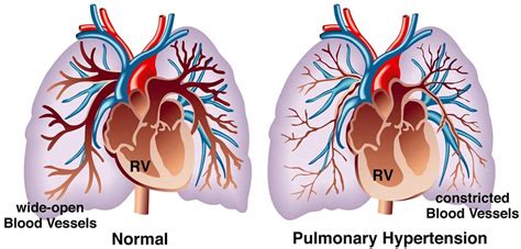 Pulmonary hypertension & pulmonary arterial hypertension causes, symptoms & treatment