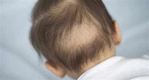 Baby hair loss: When do babies lose their hair? | BabyCenter